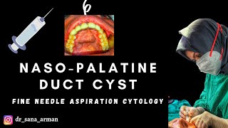 Nasopalatine Duct Cyst [upl. by Ettenoitna454]