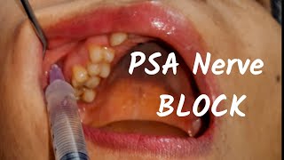 Posterior Superior nerve Block PSA Inj in dentistry Landmark amp Technique in Dental Teeth Surgery [upl. by Lunn22]