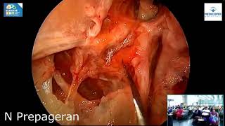 Module 5 Endoscopic Vidian Canal Meckels Cave and Lateral Sphenoid Recess Exposure of Skull Base [upl. by Debby]