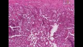 Histopathology LungAbscess bronchopneumonia [upl. by Glavin]