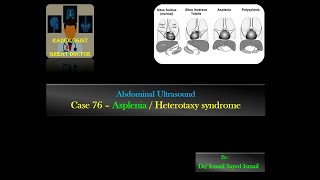 Ultrasound Case 76 Asplenia  Heterotaxy Syndrome [upl. by Cobbie645]