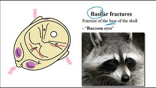 USMLE ACE Video 201 Basilar Skull Fracture [upl. by Atinauj]