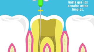 Endodoncia paso a pasovideoclip de endodoncia [upl. by Gabbie]