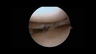 Arthroscopy of the Knee with Partial Meniscectomy  Daniel Quinn MD [upl. by Watts]