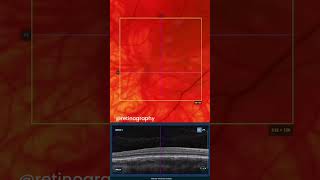 Foveal hypoplasia in ocular albinismretina oftalmo ophthalmology oftalmologia oftalmología [upl. by Knowland]