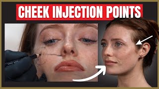 The Best Cheek Filler Injection Points  Where to inject the cheek for beautiful results [upl. by Ansell]