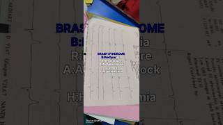 BRASH SYNDROMEECGHYPERKALEMIAecginterpretation medicine medschool ckdpatient mrmc kidney [upl. by Anastice]