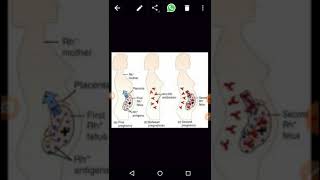 hypersensitivity type 2 part 2 [upl. by Yelsel]