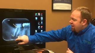 Dr Johnston a denver dentist describes a Root Canal Retreat [upl. by Kosak503]