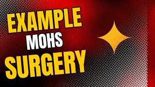 Example of Coding of Mohs Micrographic Surgery  Dr Rams Medical Coding Academy [upl. by Alyakam891]