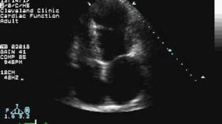 Apical Wall Motion Abnormality [upl. by Hacissej534]