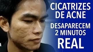 Cicatrizes de Acne Antes e Depois de 2 Minutos [upl. by Deegan]