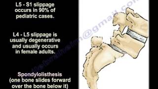 SpondylolysisSpondylolisthesisSpondylitis Spondylosis EverythingYou Need To Know Dr Nabil Ebraheim [upl. by Brucie]