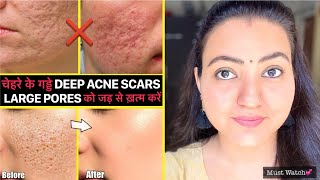 The FASTEST Way to Rid Acne  Dr Berg [upl. by Iur]