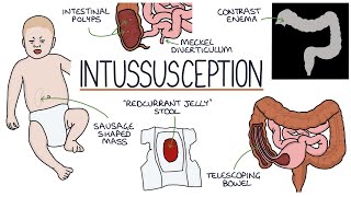 Understanding Intussusception [upl. by Gnad]