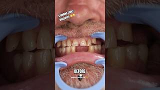 Amazing Clip On Veneers Before and After  Brighter Image Lab shorts [upl. by Negris529]