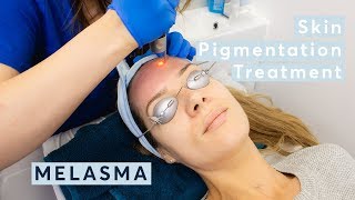 Melasma Skin Pigmentation Treatment using PicoSure Laser [upl. by Grochow797]