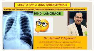 Radiology Chest X Ray5 HINDI Bronchiectasis Emphysema ILD Pulmonary Edema NoduleDr Hemant [upl. by Lorrin]