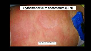 Erythema Toxicum Neonatorum  Pediatrics [upl. by Selym]