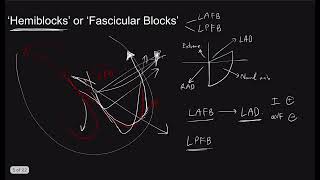 Bundle Branch Block the Series Part 2 AdvancedHemiBifascicular blocks I The Pacemaker [upl. by Ethel808]