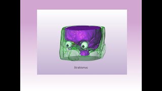 3D Presentation of types of Strabismus [upl. by Severen]