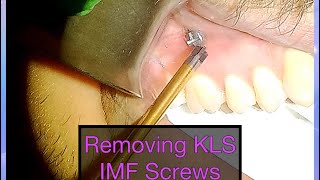 Long Version IMF Screw Removal for Closed Reduction of Mandible Fracture [upl. by Sioled79]