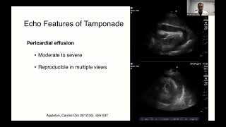 Echocardiography for Pericardial Effusions and Tamponade [upl. by Arleen]