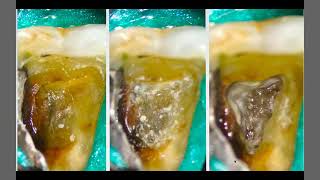 Tips and tricks for management of Calcified teeth Dr Zaher Altaqi [upl. by Kobe]