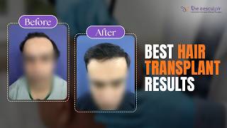 Best Hair Transplant Before After Results Delhi  Treatment of Receding Hairline  Grade 3 Baldness [upl. by Eedya]