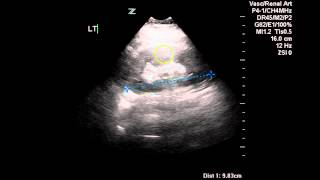 Normal Renal Arterial Doppler  Case Study [upl. by Janean618]