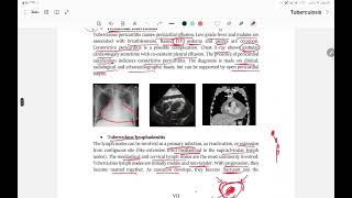 extrapulmonary TB and diagnosis of TB [upl. by Nepil]