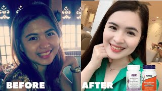 GLUTATHIONE BEFORE AND AFTER How to whiten skin [upl. by Nylkcaj]