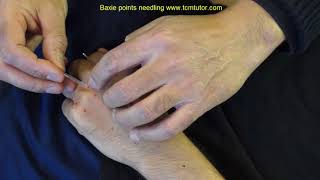 How to needle Baxie Eight Pathogens points [upl. by Nauqed]