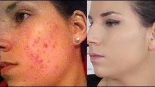 COMMENT JE CAMOUFLE MON ACNE  The Beauty Progress [upl. by Telrahc]