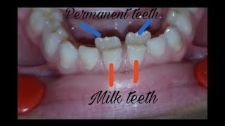 Over retained deciduous teeth milk teeth extraction  dental issues [upl. by Thoer]