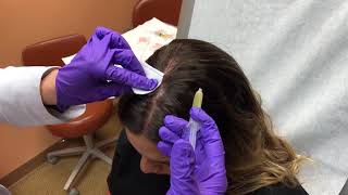 PRP injections for hair loss by Dr Rebecca Baxt [upl. by Drucie]