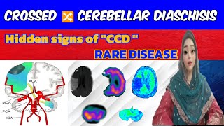 Crossed Cerebellar Diaschisis  Causes Symptoms Diagnostic Insights and Treatment Strategies [upl. by Annaiek]