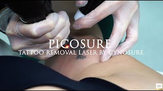 Picosure laser tattoo removal Derma revive [upl. by Marjorie]