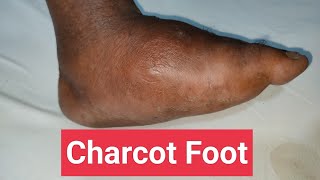 Understanding Charcot Foot in Diabetes Symptoms Treatment and Care [upl. by Quentin]