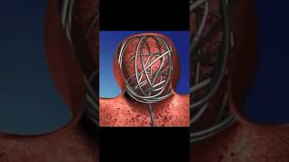 Brain aneurysm non surgery treatment  coiling  Dr Dharav  Mumbai coiling brainaneurysm [upl. by Annaitsirhc]