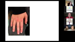 Juvenile Dermatomyositis JDM  Rare Rheumatic Disease Talks [upl. by Atekihc]