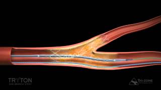 Tryton Side Branch Stent Deployment Sequence [upl. by Laroy536]