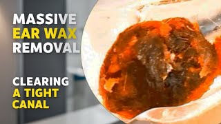 Clearing a Tight Ear Canal of Massive Ear Wax [upl. by Hippel225]