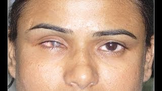 Shrunken Blind Eye Phthisis Bulbi Treated With Artificial Prosthetic Eye Fitting [upl. by Eicam]