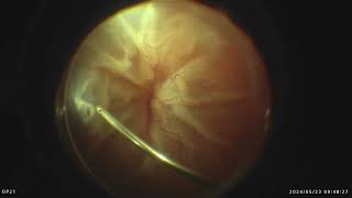 Surgery of funnel shaped retinal detachment hopeless or not [upl. by Yeltnarb910]