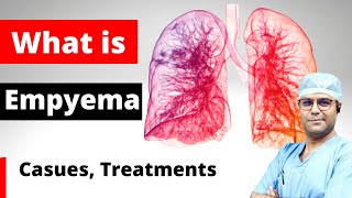 🔴 What is Empyema  Empyema Causes And Treatment shorts Empyema WhatisEmpyema [upl. by Ennove]