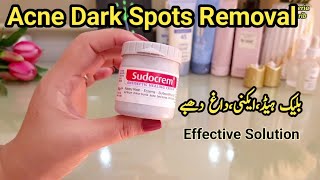 Acne Dark Spots On Face Removal Treatment Plus Blackhead Removal Clear Skin Cream [upl. by Artemis]