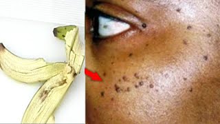 QUICK AND SIMPLE REMOVE SKIN TAG LOOK WHAT I USE [upl. by Ajnot994]