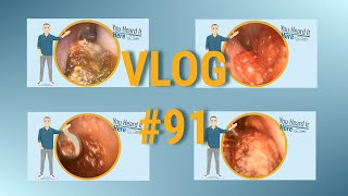 EPIC Earwax Removal Compilation  VLOG 91 [upl. by Zuzana135]