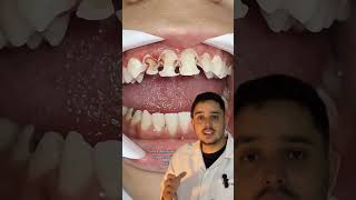 UM ALERTA PARA TODOS OS PAIS 🚨 alerta chocante carie dentes dentista [upl. by Neenaj]